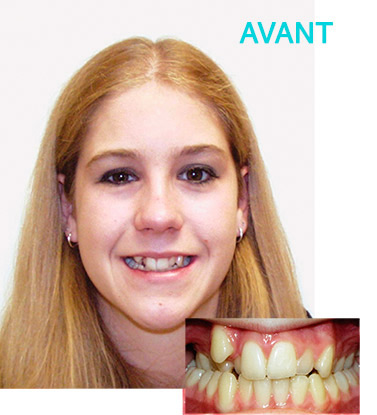 Fille bagues avant