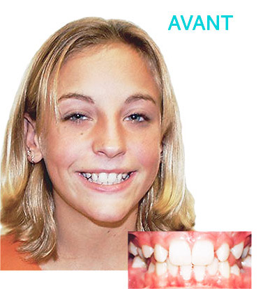 Fille bagues avant