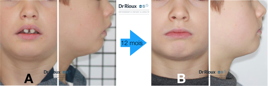 Myobrace avant après
