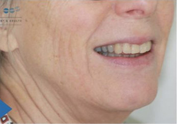 Senior Invisalign Après
