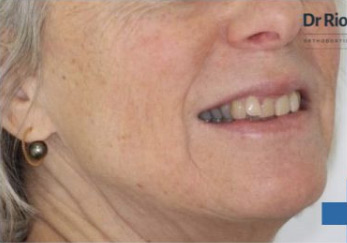 Senior Invisalign Avant